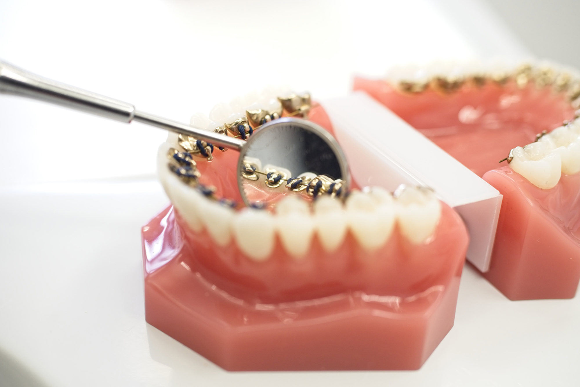 Um Die Zähne Des Tages Zu Korrigieren ,Clear Die Erste Stufe Erwachsene Kieferorthopädische Zweistufige Unsichtbare Zahnspangen Um Die Boxklammern Zu Behalten